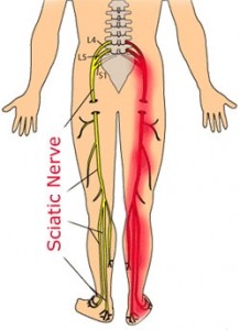 sciatic-nerve pain diagram Frederick Chiropractors offer treatment for Sciatica Pain